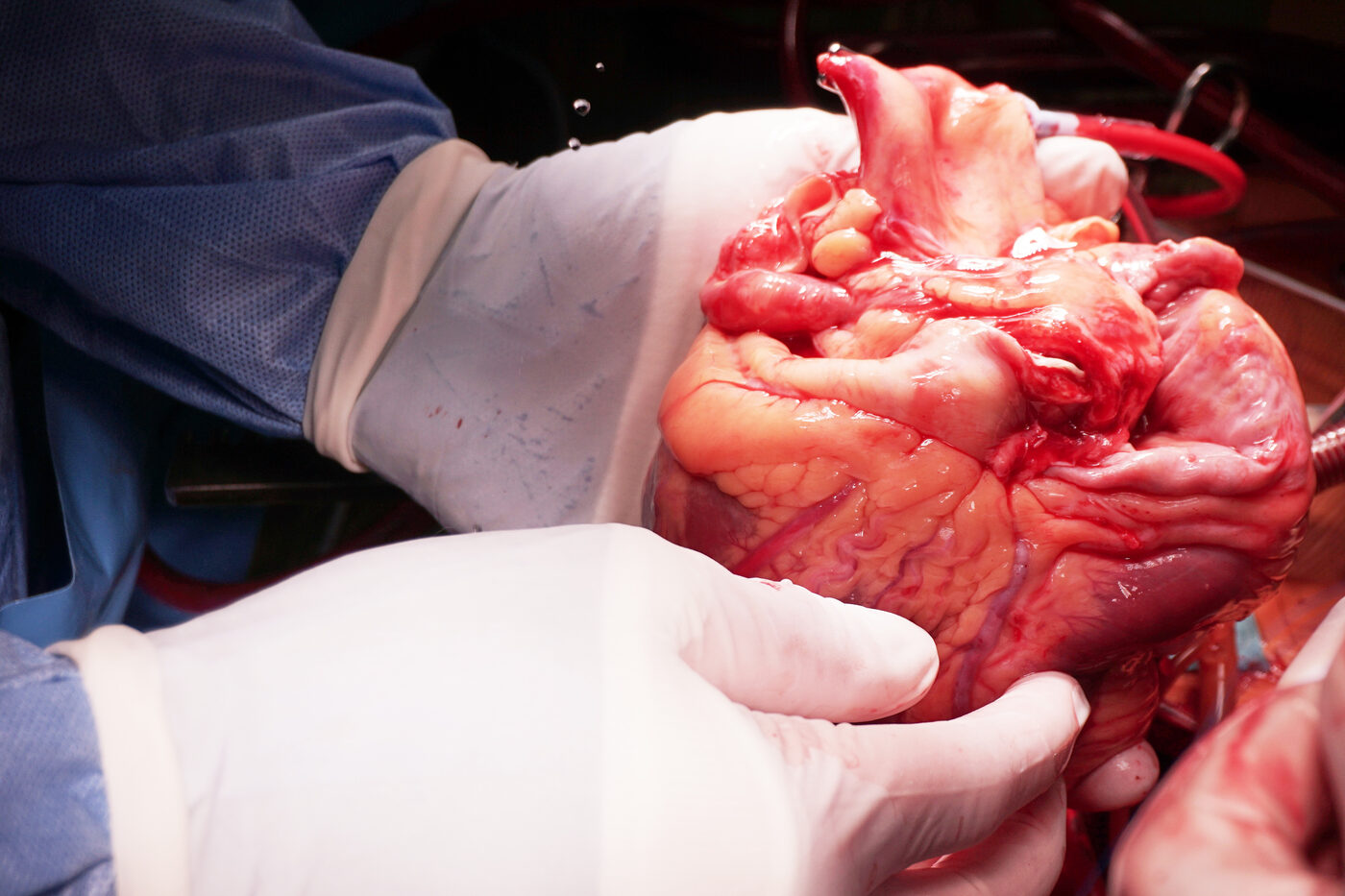 Srčna kirurgija / Cardiac surgery